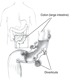 Diverticulosis and Diverticulitis